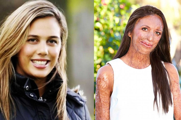 Bush fire victim ex-model Turia Pitt